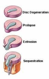 San Francisco Personal Injury Lawyer Talks on Types Of Lumbar Herniated Discs