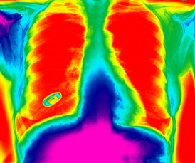 New York City medical malpractice Alert: New study finds CT lung scans can lead to many false alarms