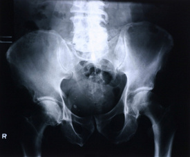 Johnson & Johnson’s DePuy issues recall of hip replacements