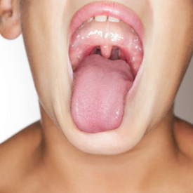 Study: Children who have their tonsils removed gain weight
